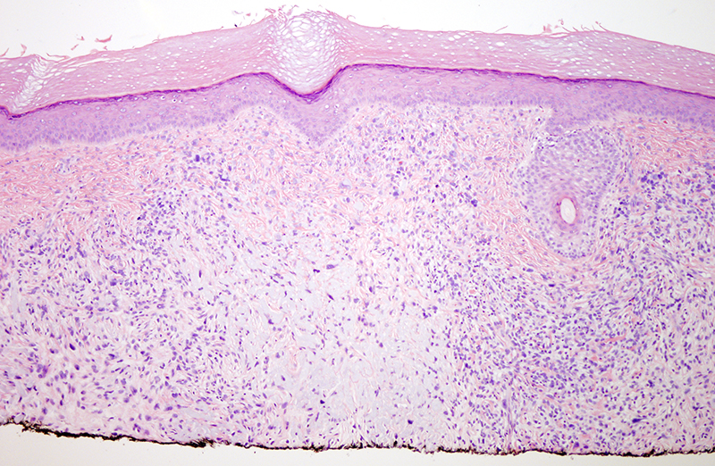 Slide 2: The dermal based neoplasm exhibits a haphazard as well as focally storiform growth pattern while sparing the epidermis. The tumor cells are set in a fibrous and elastotic stroma.
