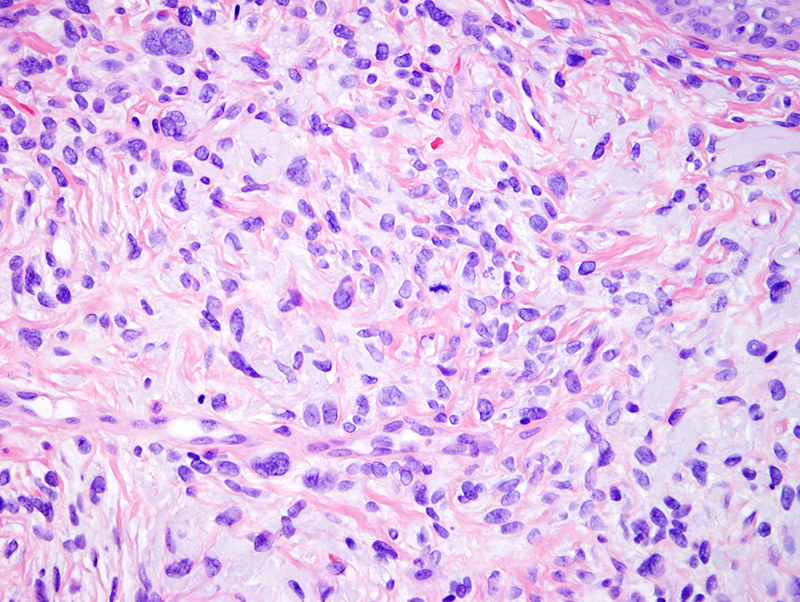 Slide 3: The tumor cells are markedly pleomorphic, spindled to epithelioid nuclei and occasionally multinucleated forms. Mitotic figures are present averaging approximately 4/10 HPFs
