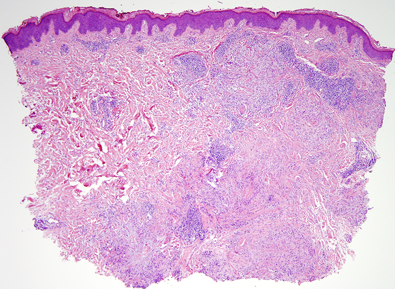 Slide 1: 64 year-old woman with multiple nodules of the elbows.