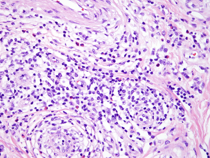 Slide 3: There are also many eosinophils that percolate through the dermis including in the zones of lymphoplasmacytic infiltration.  There are also scattered plasma cells. The vessels are lined by hobnailed epithelioid appearing endothelium.
