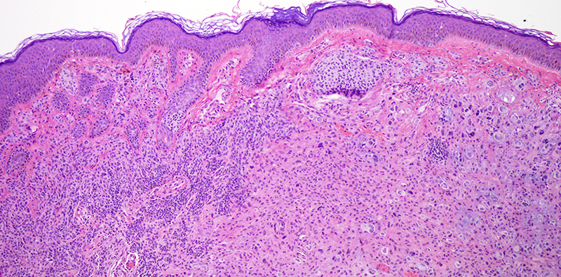 Slide 2: The excision specimen shows a significantly atypical dermal based melanocytic tumor (right) arising in association with a more conventional benign compound nevus (left).