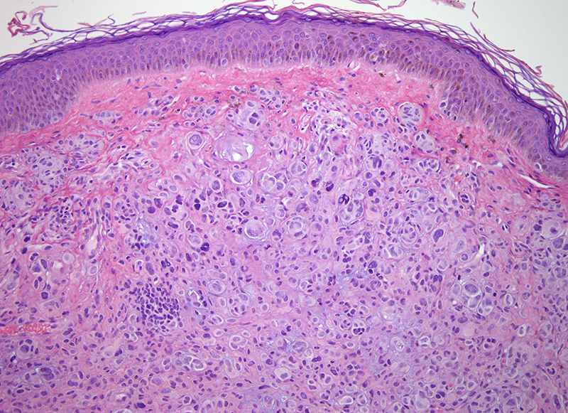 Slide 4: The tumor distorts the dermis resulting in a polypoid alteration of the dermis. The cells have a large bizarre epithelioid appearance.  These cells are disposed singly and in small nests. There is considerable cell to cell heterogeneity.  Many of the cells show large nuclei with a tendency toward multinucleation.  A number of the cells have nuclear pseudoinclusions.  The atypia is severe cytomorphologically and architecturally.  The cytomorphology is somewhat spitzoid in appearance as one might encounter in an least an atypical Spitz's tumor. There are scattered mitotic figures. The mitotic rate is roughly 1 per mm2.