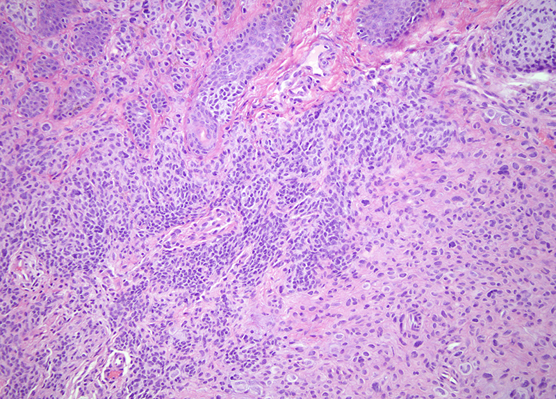 Slide 5: Junction between conventional compund nevus (left) and atypical epithelioid melanocytic proliferation (right).
