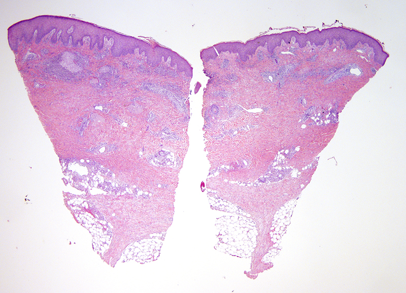 Slide 1: 30 year-old woman presenting with cough, night sweats and numerous ulcerated nodules of bilateral arms. The epidermis is acanthotic with regenerative changes.  Even from this magnification we can appreciate a dermal based inflammatory process with extension into the subcutaneous adipose tissue.