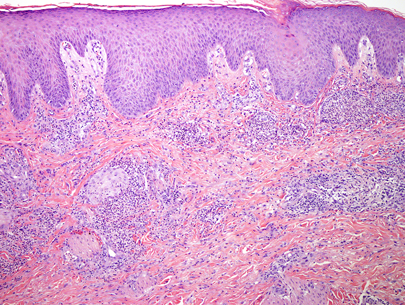 Slide 2: The biopsy shows superficial coalescing nodular foci of neutrophilic and granulomatous inflammation.