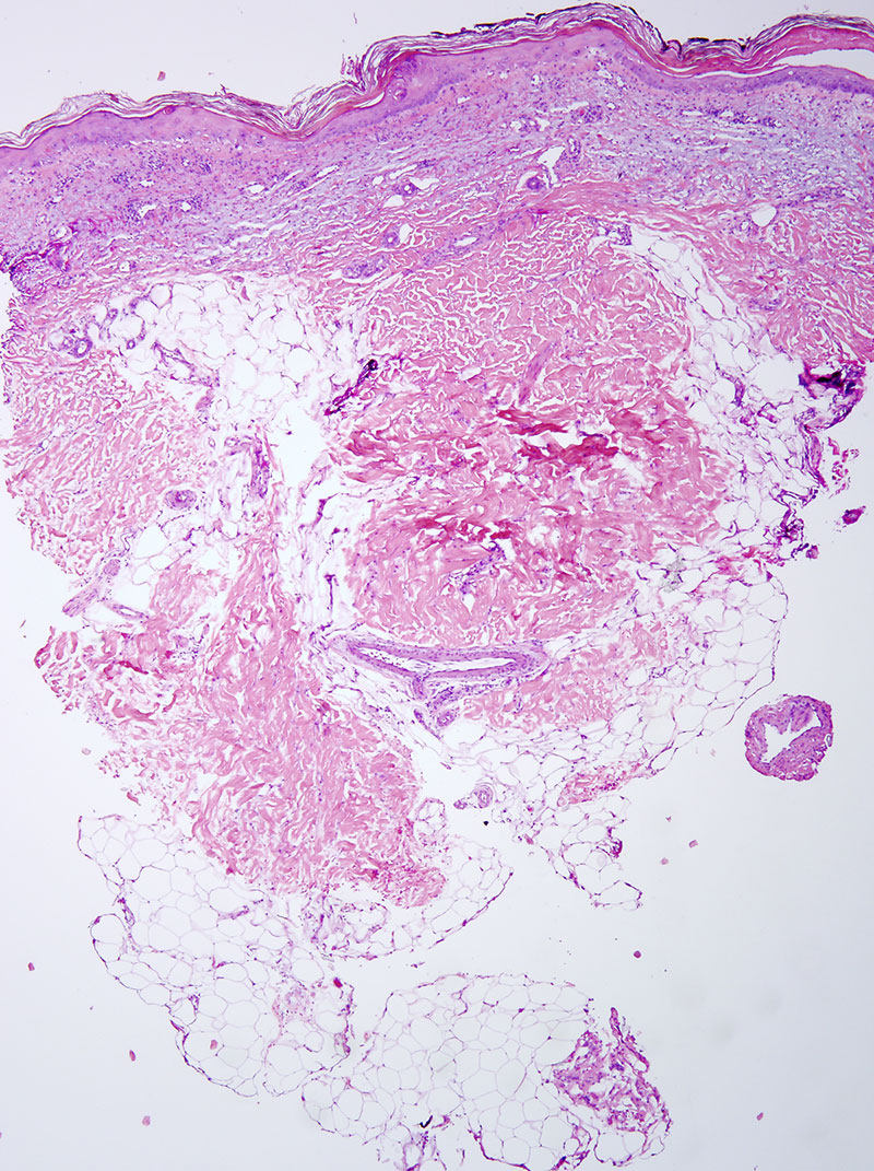 Slide 1: 63 year-old woman with a multiple erythematous macules of the elbow. The patient is being treated with Capecitabine for metastatic breast carcinoma. The clinical suspicion is that of a drug reaction.