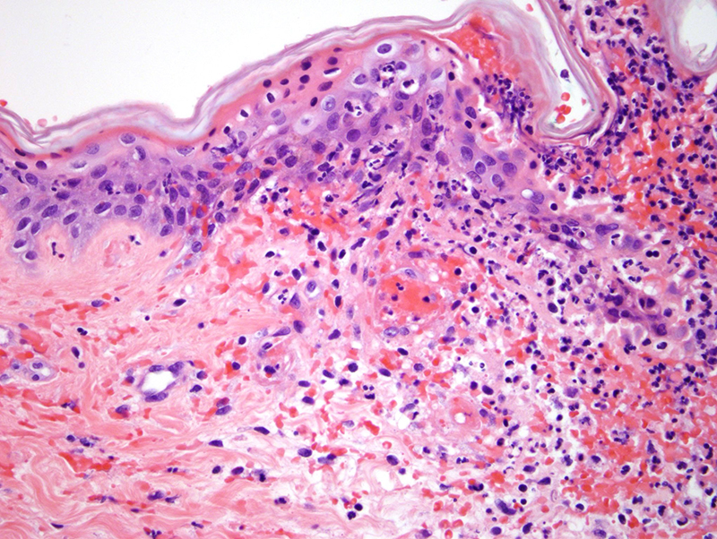 Slide 2: The vascular endothelium in the reticular dermis and subcutaneous fat exhibit necrosis with endothelial cell sloughing accompanied by a modest inflammatory cell infiltrate. A true primary vasculitic process however is not observed.