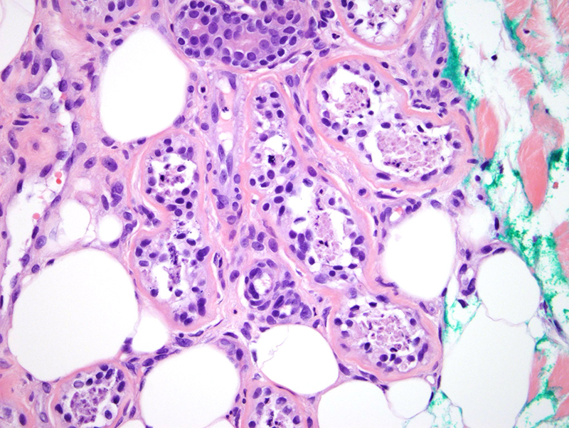 Slide 4: Ulceration accompanied by striking necrosis of the eccrine coil. Elsewhere there were cellular degenerative changes similar to those seen in the eccrine coil present in the hair follicle