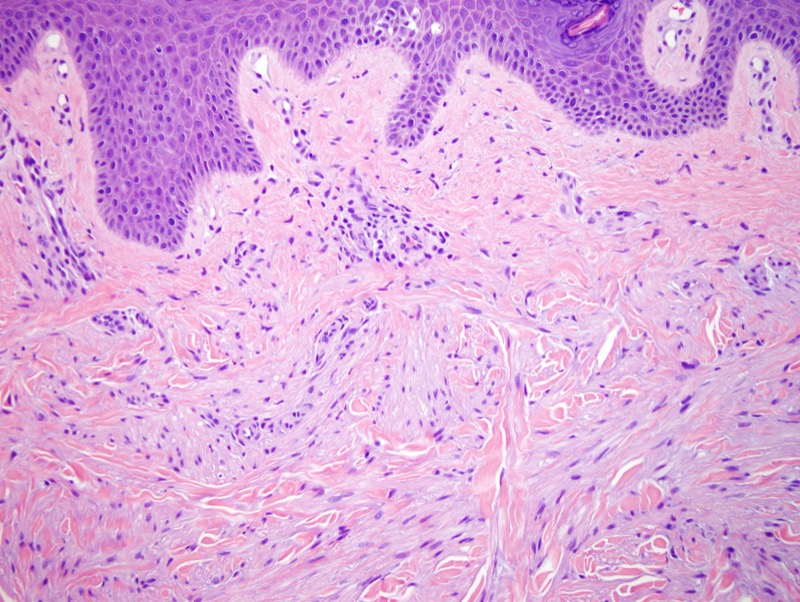 Slide 2: The dermis contains solid areas with short, intersecting fascicles of bland spindled cells with eosinophilic cytoplasm.