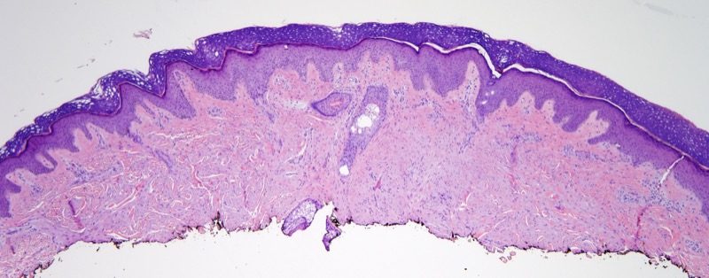 Slide 1: 40 year-old woman with a knee lesion. <br>The resection specimen reveals a dermal based proliferation.