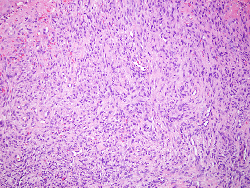 Slide 4: This vasoformative lesion is composed of relatively uniform appearing cells with round to oval nuclei and inconspicuous nucleoli.  They are interposed by blood vessels that have prominent basement membrane zones. An HHV-8 stain was negative, ruling out Kaposi's sarcoma.