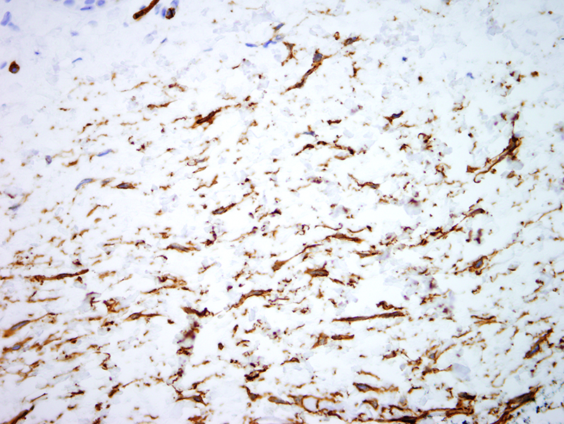 Slide 4: CD34 shows extensive staining of the lesion.