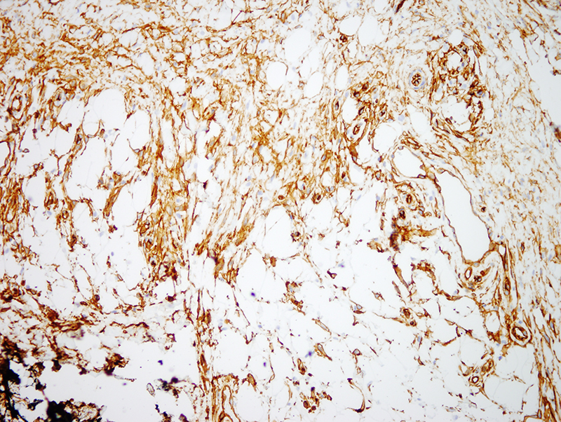 Slide 8: Immunostaining is also noted for CD34. The fact that there is hybrid staining pattern with both CD34 and Factor-XIIIA corroborates the categorization of this lesion as a cellular dermatofibroma.
