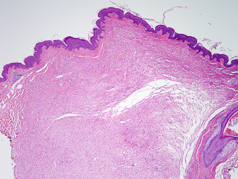 Slide 1: 60 year-old woman with an upper back pink flesh colored rubbery papule. On lower power examination, a Grenz zone separates the lesion from the undersurface of the epidermis.