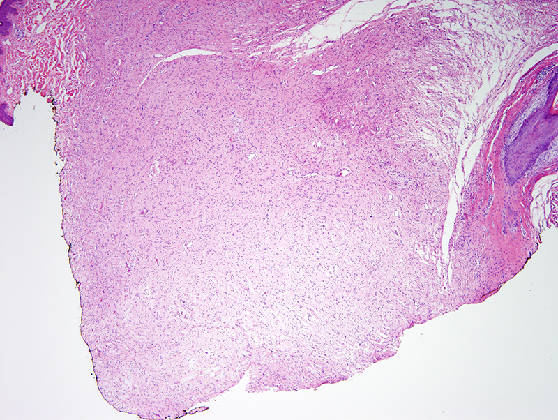 Slide 2: The specimen comprises a non-encapsulated tumor composed of delicate fascicles of cells.