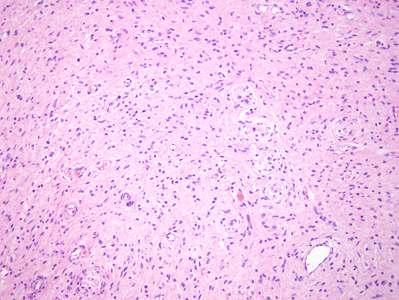 Slide 3: The proliferation is associated with is increased vascularity along with a smattering of mast cells.