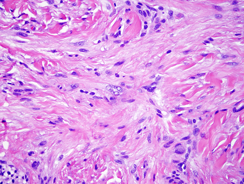 Slide 5: However, there are randomly disposed atypical cells present throughout the lesion. The tumor is highlighted by SMA, desmin, caldesmon, and calponin; the proliferation index is low (i.e. <5%).