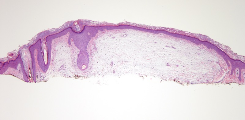 Slide 1: 60 year-old man with a smooth papule of the left knee, R/O dermatofibroma. <br><br>Low power examination reveals striking distortion of the dermis by abundant mucin. The lesion is non-encapsulated and demonstrates a multilobulated growth pattern.