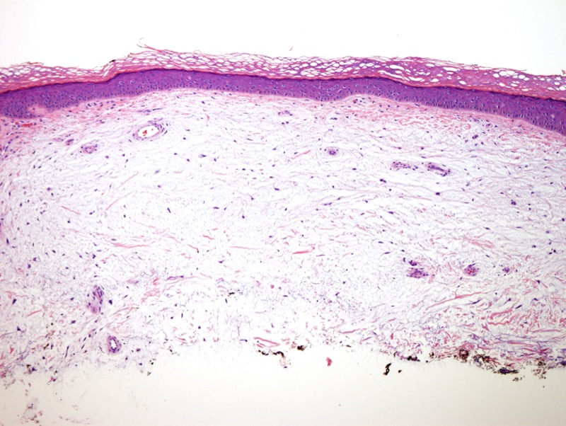 Slide 2: This mucinous nodular distortion of the dermis is accompanied by a proliferation of spindled cells.