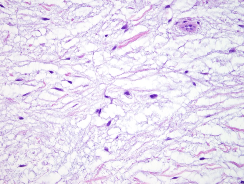 Slide 3: These cells appear quite bland.  The nuclei are round to oval; nucleoli are barely discernible.  The cytoplasms are eosinophilic and fibrillar in quality.  There is no significant cellular atypia.