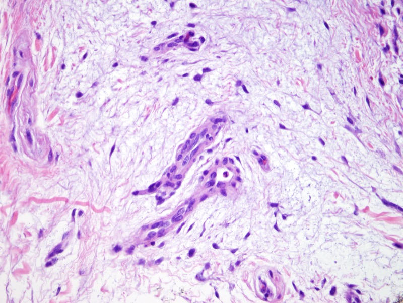 Slide 4: A few blood vessels course through the lesion. The differential diagnosis of this lesion is primarily between focal cutaneous mucinosis and a cutaneous myxoma/superficial angiomyxoma. The latter diagnosis is favored given the multilobulated nature of  the lesion and the extent of CD34 positivity (NEXT IMAGE) amid the spindled cells found within this lesion.