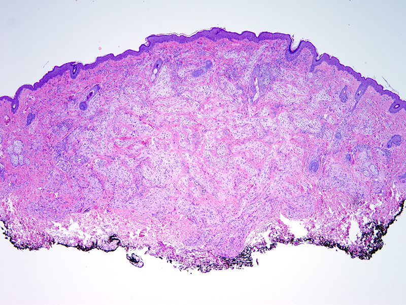 Slide 1: 13 year-old girl with a chin lesion. The lesion is located within the dermis.  A narrow grenz zone separates the lesion from the overlying epidermis.