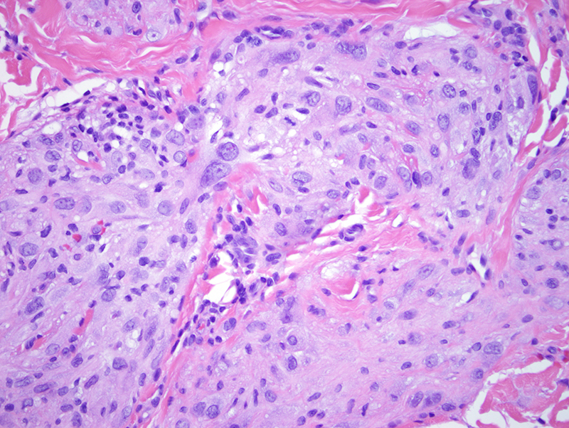 Slide 4: This unusual epithelioid proliferation is without significant cytomorphologic or architectural maturation. The cells are predominantly large epithelioid ones that have abundant lightly eosinophilic to amphophilic cytoplasm. There is a significant degree of nuclear atypia. There are scattered cells that show significant nuclear enlargement, hyperchromasia and multinucleation.  Overall the pleomorphism is in the moderate realm. The background stroma has a hyalinized appearance.  There is a very focal lymphocytic infiltrate. A few mitotic figures are identified.