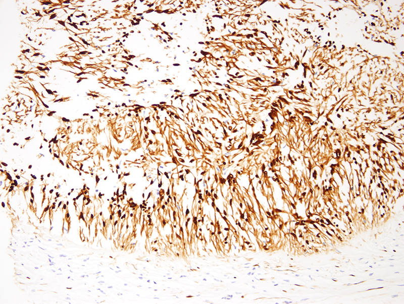 Slide 6: S100 in the Verocay body-like arrangements. The findings are highly characteristic for a benign peripheral nerve sheath tumor. The lesion is growing within nerves in a multinodular fashion.