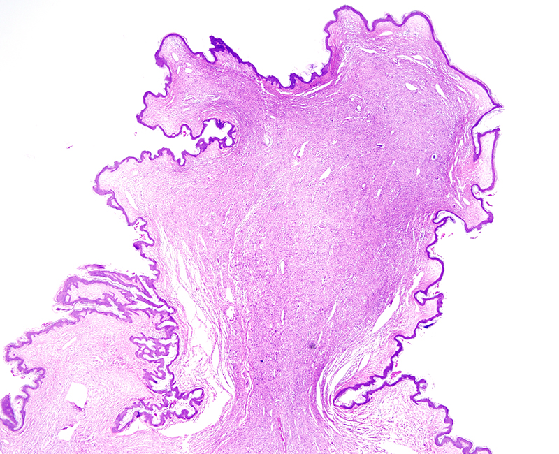 Slide 1: 74 year-old woman with a lower back "skin-tag". The lesion is a relatively cellular dermal-based proliferation. A Grenz zone separates the lesion from the undersurface of the epidermis.