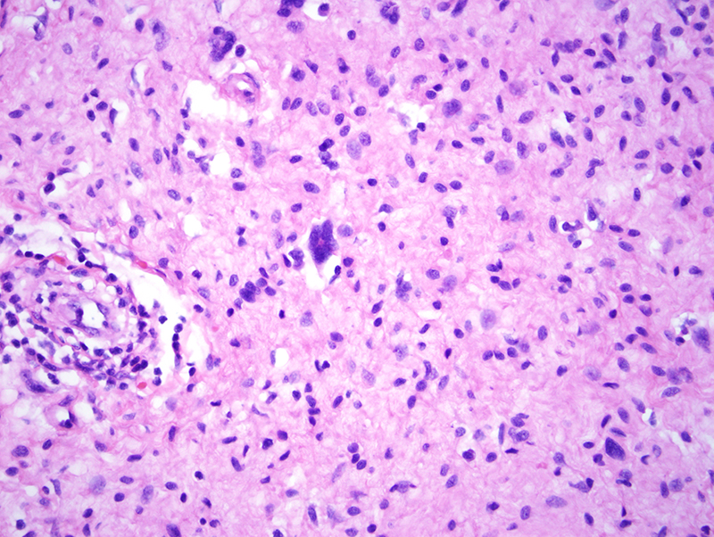 Slide 3: There are these peculiar floret-like multinucleated cells which is a rare phenomenon that has been described in neurofibromas.  This finding could be indicative of senescent change. Immunohistochemical staining reveals positivity of the floret-like multinucleated cells with CD34 and a lack of staining with S100, CD68 (KP1) and Factor XIIIa. The slender neurofibroma cells are diffusely positive with S100.  The positivity of the multinucleated cells for CD34 without staining for S100 is characteristic for this benign variant of neurofibroma.