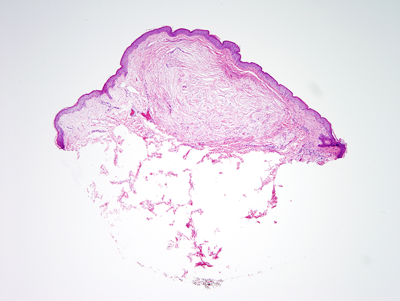 Slide 1: 52 year-old man with a neck pink papule.