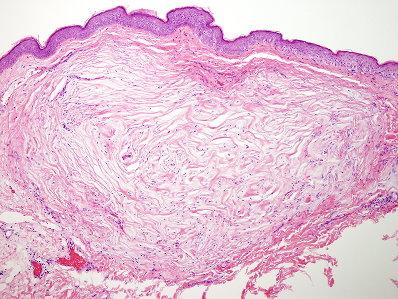 Slide 2: The biopsy shows a somewhat storiform fibrosing lesion accompanied by fibrocyte hyperplasia with a narrow grenz zone that separates this spindled lesion from the overlying epidermis.