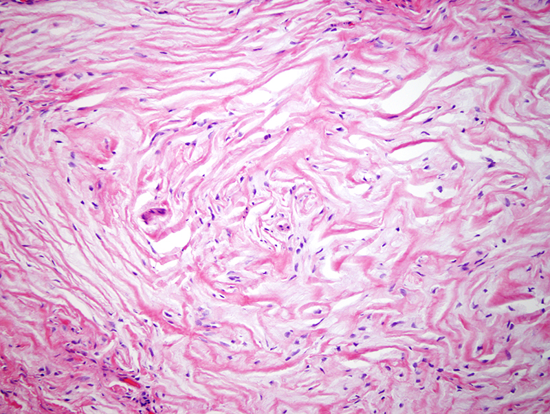 Slide 3: The spindle cell proliferation has a distinct whorled sclerotic appearance.