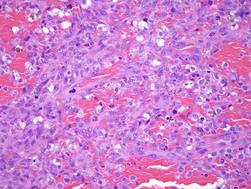 Slide 5: This very cellular lesion is associated with mitotic activity and as well there are areas of significant cellular atypia.
