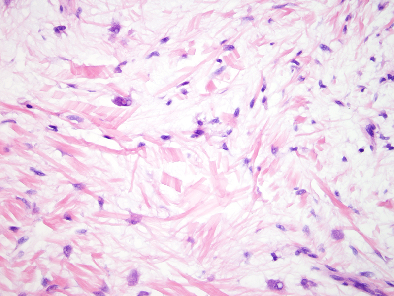 Slide 3: The cells are attenuated spindled cells without significant atypia.