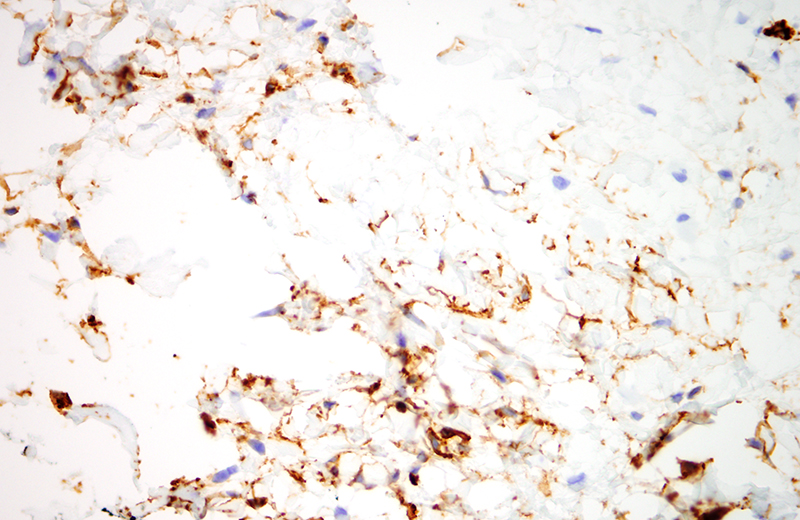 Slide 5: The spindled cells show positive staining for CD34.