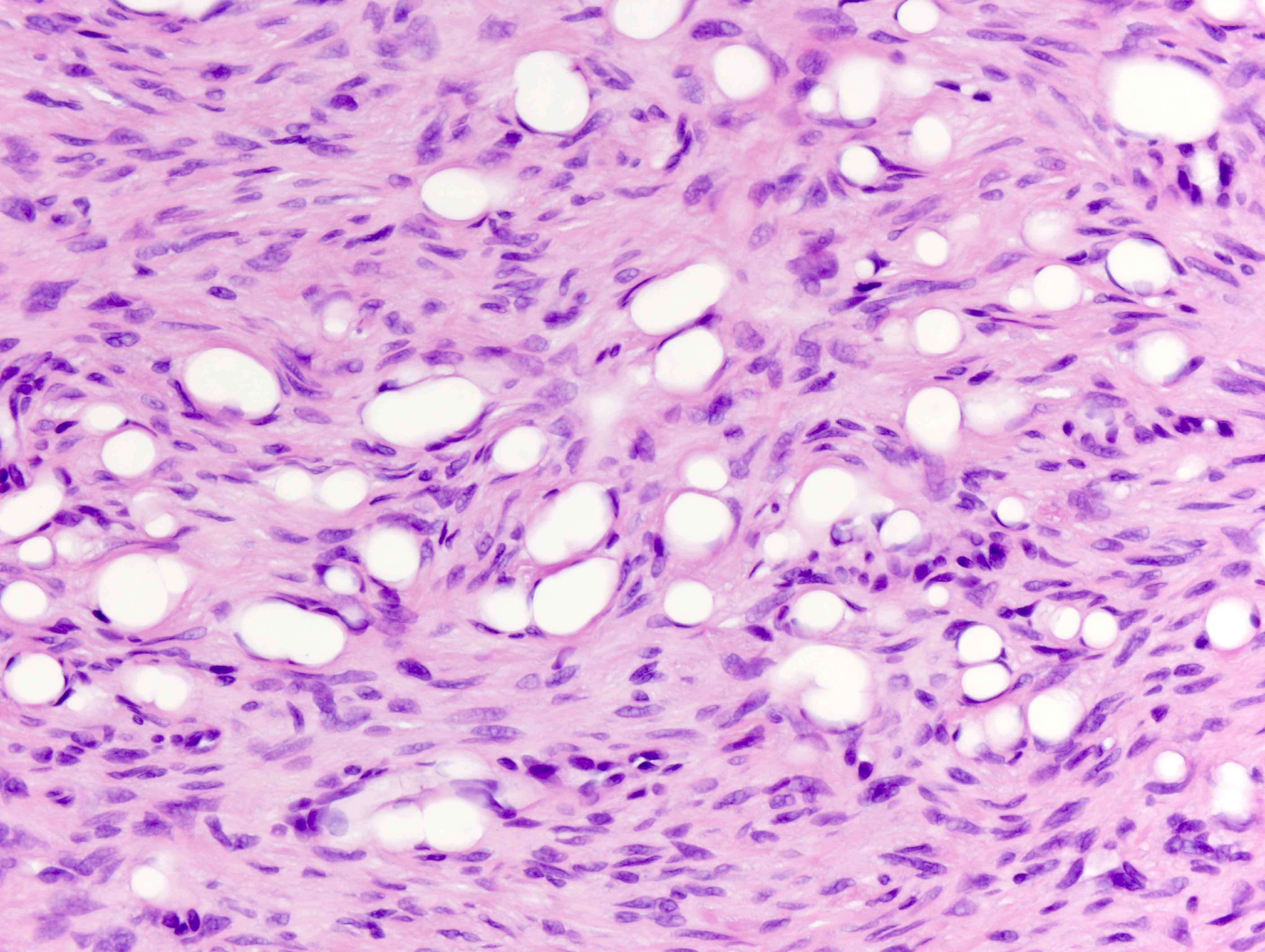 Slide 4: Cytomorphologically the cells are monomorphic appearing spindled with scant eosinophilic cytoplasm and hyperchromatic nuclei. There is minimal pleomorphism.  No significant mitoses are identified.