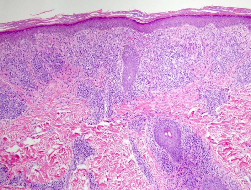 Slide 2: There is a very dense plasma cell rich infiltrate within the dermis. The infiltrate assumes a band-like lichenoid pattern superficially. There is extensive infiltration of the adventitial dermis, follicles and the eccrine apparatus by plasma cells.