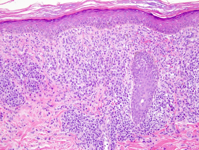 Slide 3: This is a higher power view of  the dense plasma cell rich infiltrate within the dermis with a band-like lichenoid pattern and extensive infiltration of the follicles and the eccrine apparatus.