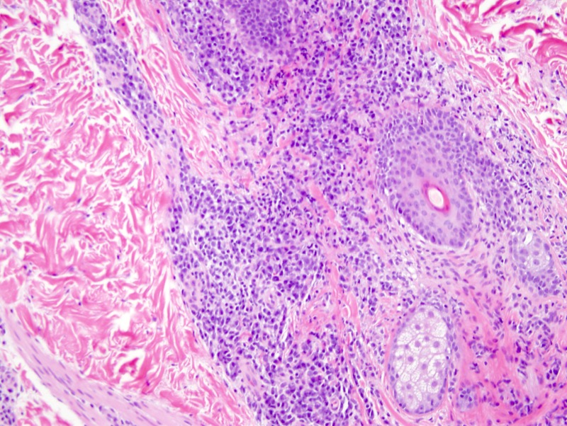 Slide 4: There is extensive infiltration of  the follicles and the eccrine apparatus by plasma cells.