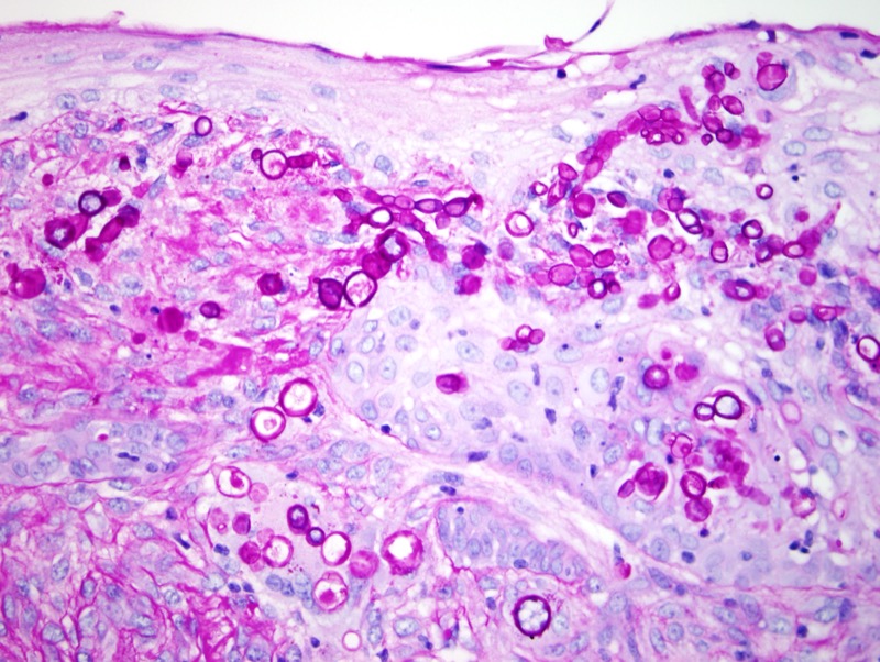 Slide 5: PAS stain highlights large irregular spores infiltrating the epidermis and found within the superficial corium.