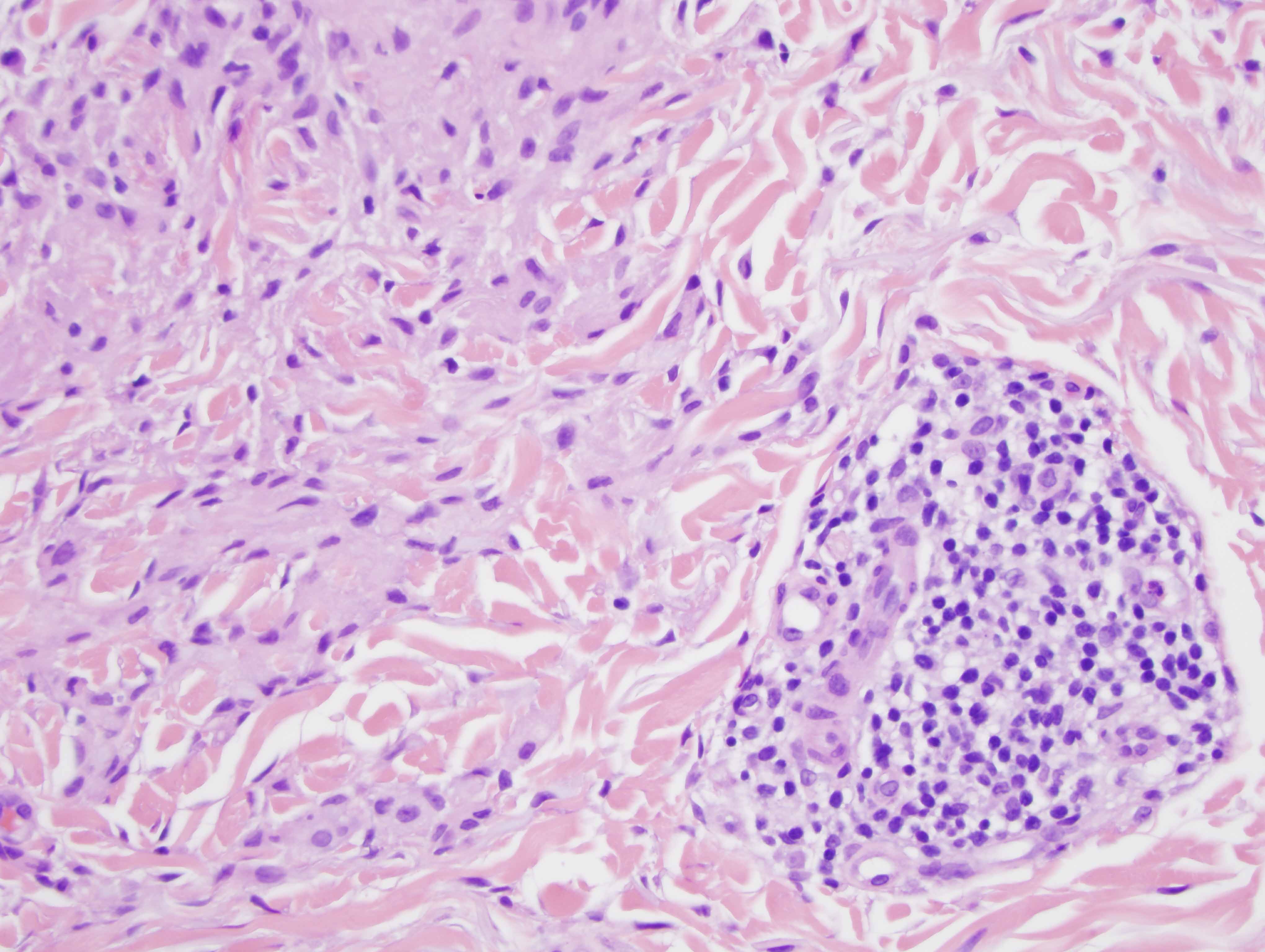 Slide 3: There is a supervening angiocentric lymphocytic infiltrate present in the superficial dermis.  A few of the collagen bundles appear somewhat sclerotic and are surrounded by histiocytes.