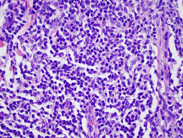 Slide 3: It is predominated by small lymphocytes with many admixed well differentiated but atypical plasma cells. The plasma cells focally assume a nodular growth pattern amidst the smaller lymphocytes. There are a few small obscured germinal centers infiltrated by the small lymphoplasmacytic infiltrate.