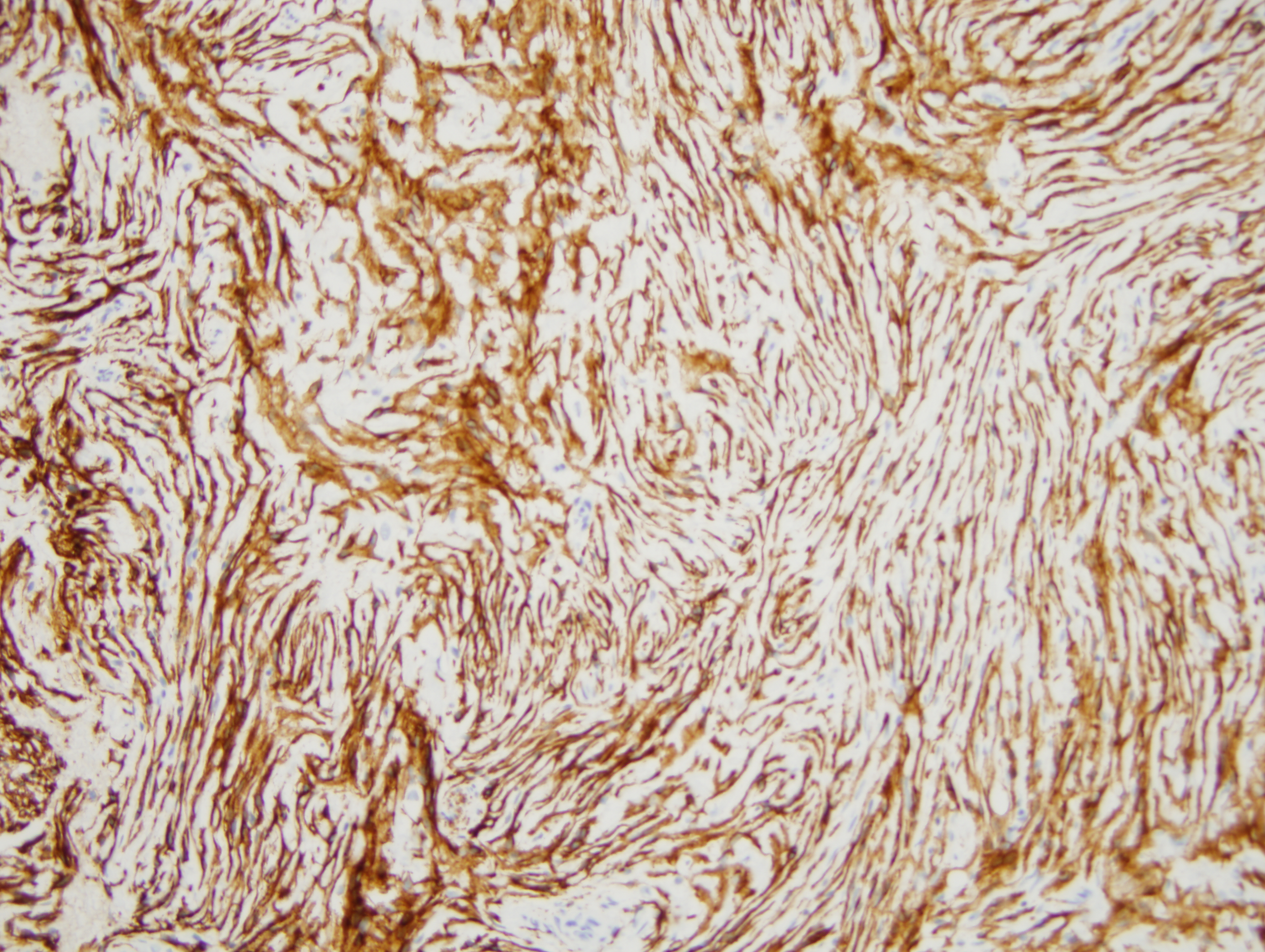 Slide 6: The cells are CD56 positive