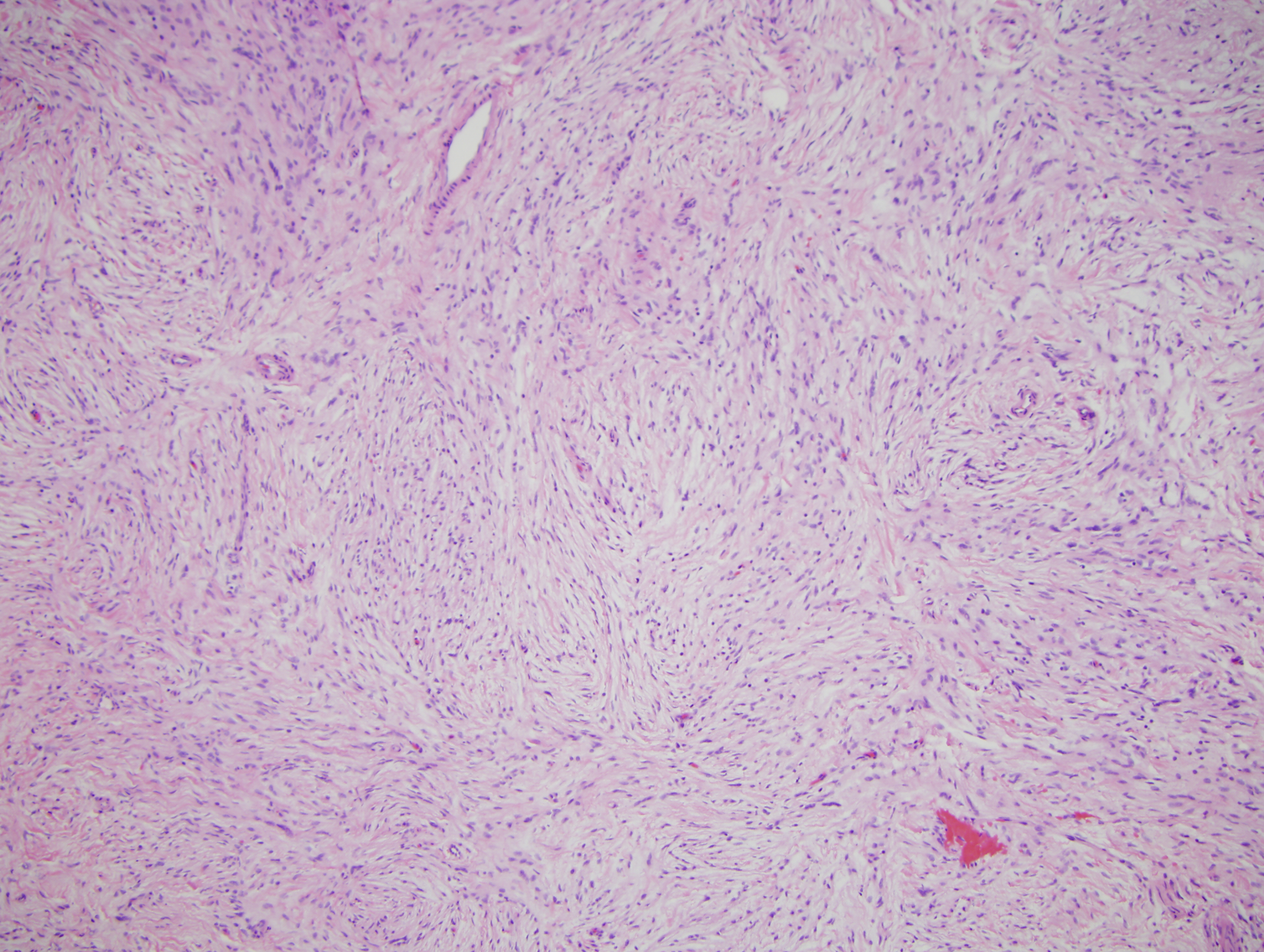 Slide 3: This lesion although being very extensive and of moderate cellularity is quite bland.