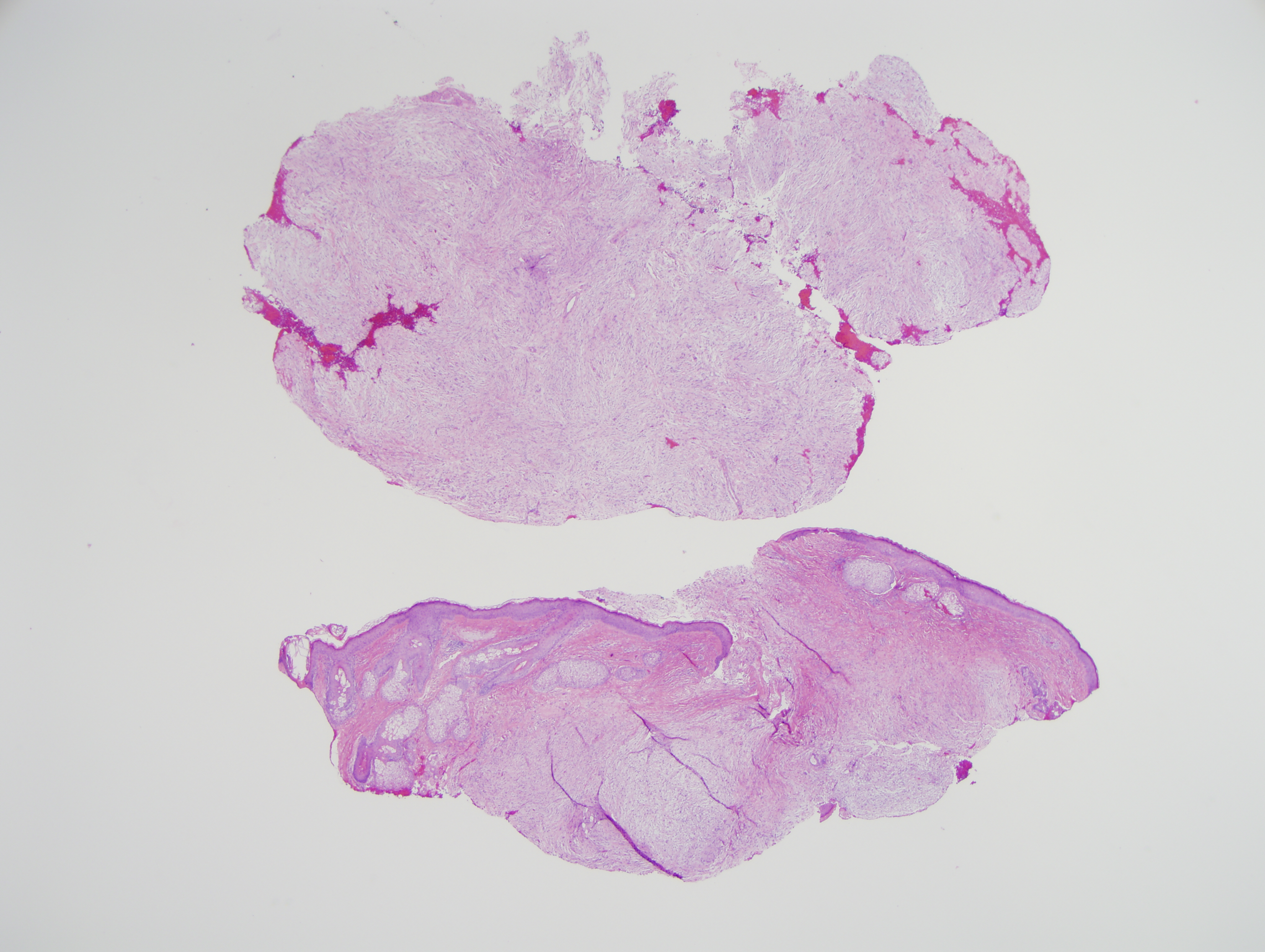 Slide 1: The excision specimen shows a very extensive bland spindle cell proliferation.