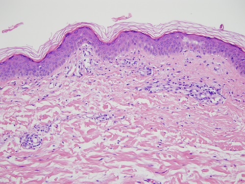 Slide 2: The biopsy shows an interface dermatitis. It is a cell poor interface process. In particular, there is basilar vacuolar change with some degree of basilar dyskeratosis accompanied by a few lymphocytes and histiocytes in intimate apposition to the basal layer of the epidermis. The epidermis is rather attenuated appearing. A suggestion of interstitial mucin is also noted. There is very focal red cell extravasation.