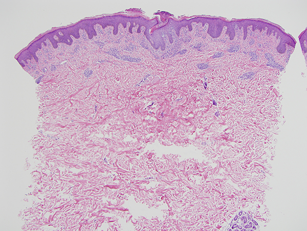 Slide 1: The biopsy shows a well differentiated superficial and deep lymphocytic infiltrate