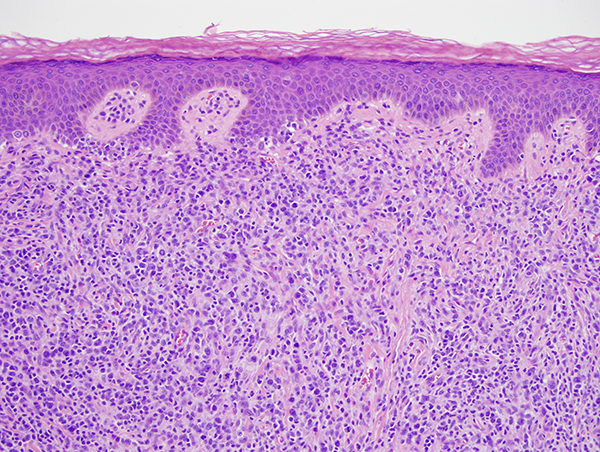 Slide 2: The biopsy shows an interface dermatitis. It is a cell poor interface process. In particular, there is basilar vacuolar change with some degree of basilar dyskeratosis accompanied by a few lymphocytes and histiocytes in intimate apposition to the basal layer of the epidermis. The epidermis is rather attenuated appearing. A suggestion of interstitial mucin is also noted. There is very focal red cell extravasation.