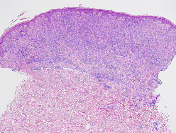 Slide 1: The biopsy shows a highly atypical lymphocytic infiltrate that is permeative of the epidermis and also assumes a tumefactive growth pattern within the papillary and reticular dermis.